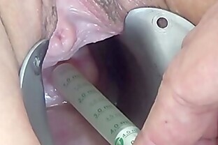 Insertion of Semen with Syringe into Uterus